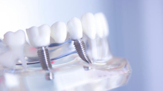 CWD Cosmetic Dentistry blog (2)-1