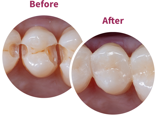 Transcend Before and After