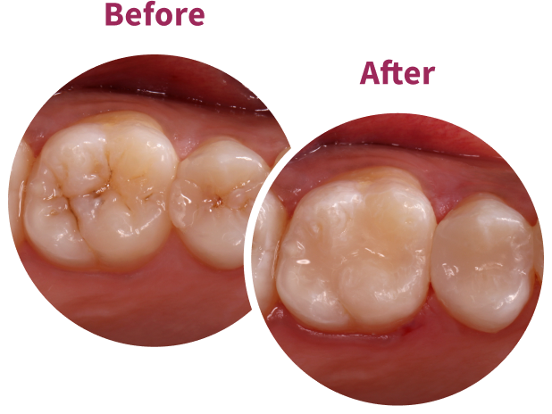 Transcend Before and After